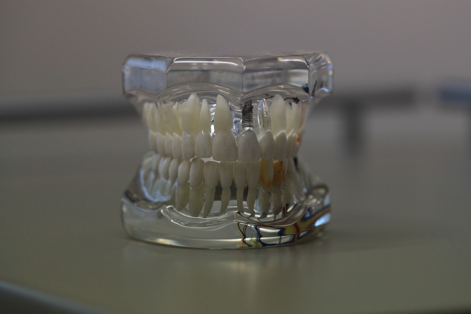 implant dentar 2 implant dentar Cum iti coloreaza viata un implant dentar implant dentar 2