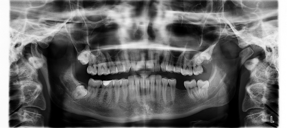 implant dentar 3